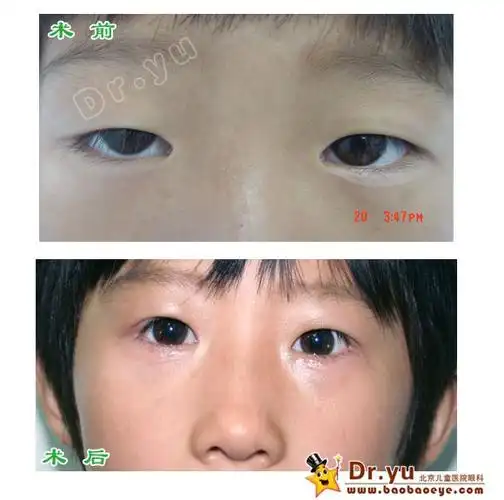 儿童上睑下垂手术前后照片集锦