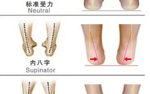 宝宝走路内八字,女儿走路内八字医院能矫正吗