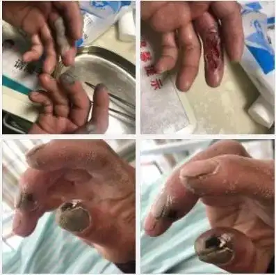 河南郑州52岁的环卫工人李宗敏19岁时因意外触电而截肢,失去双手.