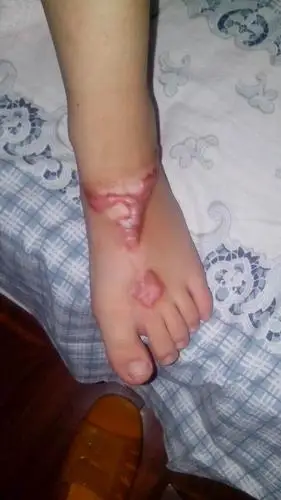 问:我女儿6岁,2月份脚被开水烫伤,经一个月左右换药后,汤伤处没有芭痕