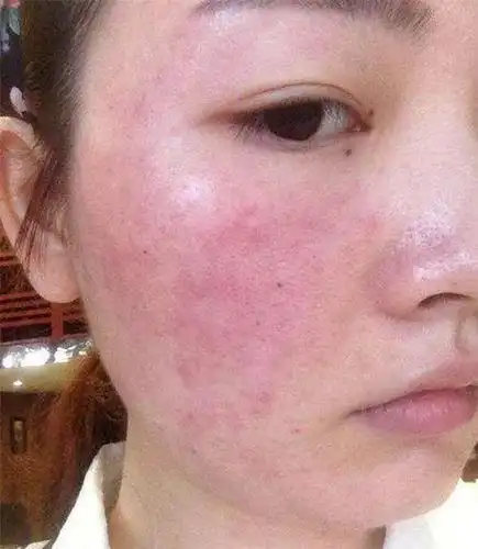 相信各位都有一样的困扰,一到冬天脸上皮肤就开始干燥蜕皮,敏感红肿