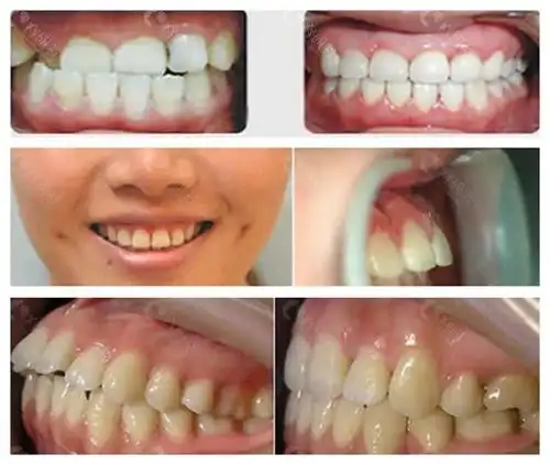 泉州维乐口腔整牙前后对比照片