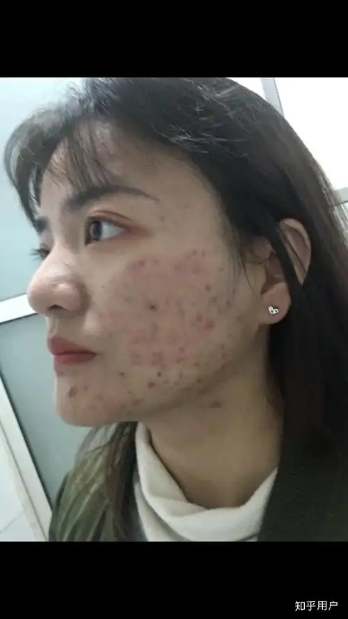 长得好看但是皮肤很差是一种怎样的体验?