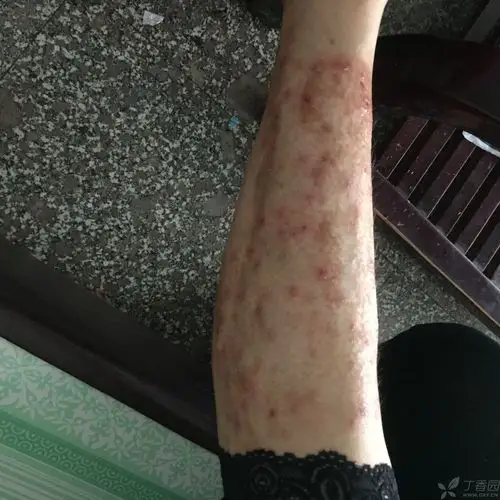 【求助】罕见皮肤病数年