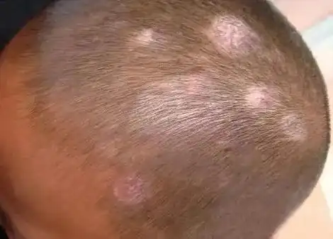 儿童头癣的初期图片 - 搜狗图片搜索