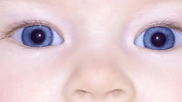 小孩眼睛近视怎么办