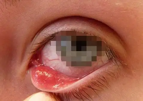 麦粒肿刚开始的图片