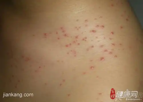 【原创】毛囊炎图片的介绍