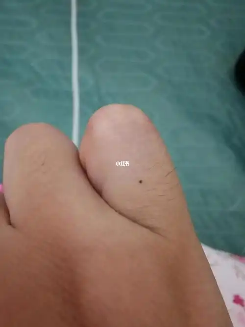 左右手都无端长了一颗痣,左手在食指,右手在尾指