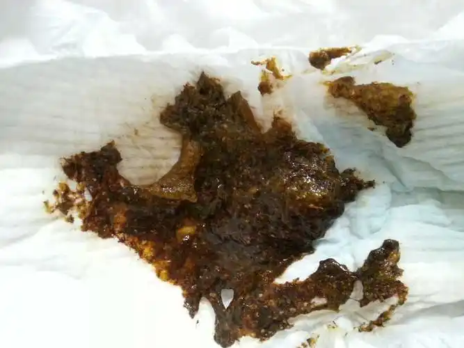 大便这个颜色,好吓人