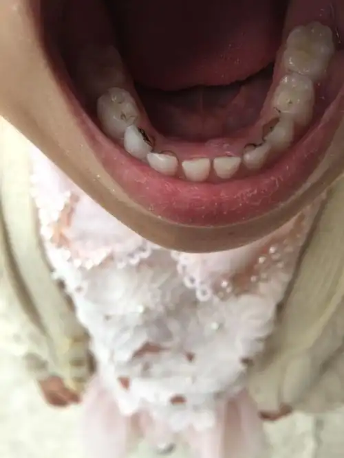 刚刚发现孩子牙龈上不该长牙的地方长了新牙,怎么办?