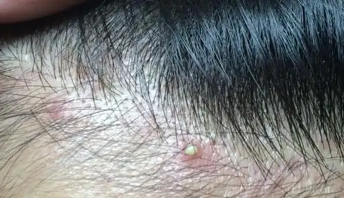 头皮毛囊炎 求大家帮帮忙 好痛苦 受其困扰好久了 大概有3年了 吃的药