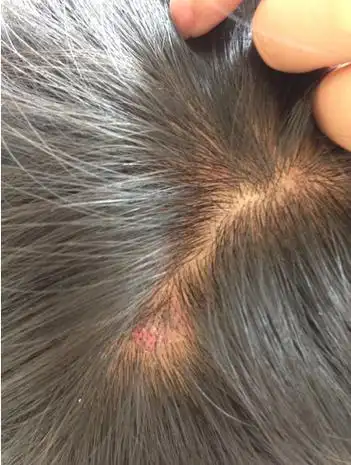 头上长痘痘是怎么回事