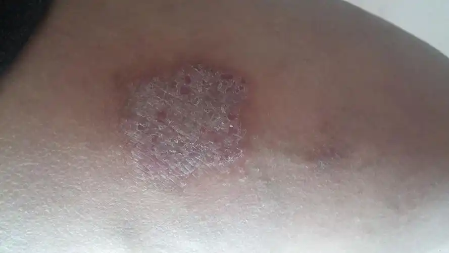 静脉曲张性湿疹淤积性皮炎