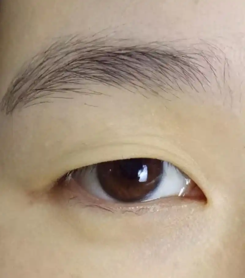 上眼皮松垂都遮挡了视野,该咋办?-南华副主任医师-爱问医生