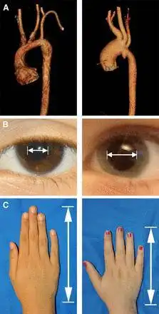 马凡综合征 -"天才病"(巨人杀手?