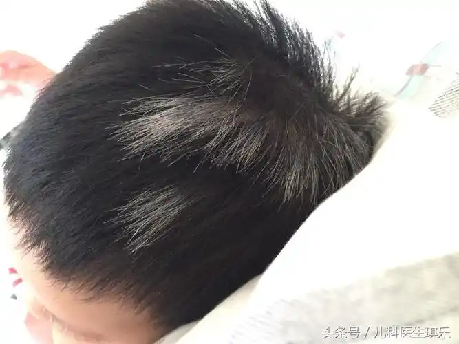 引起宝宝白发的原因有哪些?
