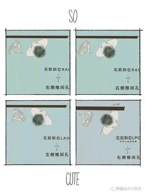 颈椎斜位的两种摆位方式怎么看椎间孔?