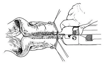图5 用gia吻合器做肠侧-侧吻合图6 用xf缝合器关闭小肠侧-侧吻合端图7