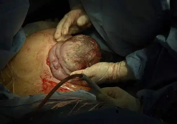 剖腹产后的6个小时后最难熬,也是最关键的6个小时,新妈妈知道了吗