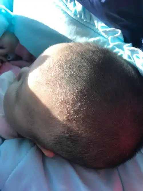 宝贝头上有干皮