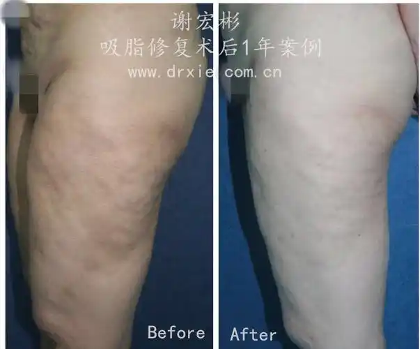 吸脂失败严重不平修复病例(高加索人种,国外吸脂手术) - 好大夫在线