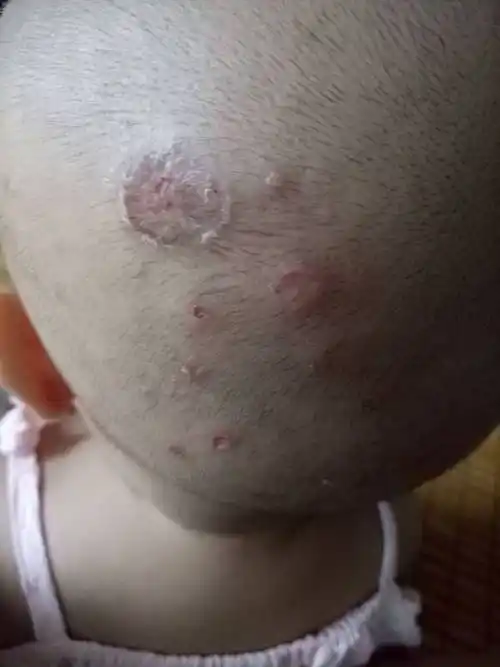 宝宝最近头上长了癣,怎么治才好?