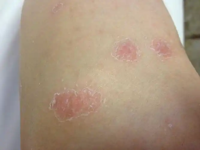 专家问答 症状问答   牛皮癣的症状为银白色鳞屑,薄膜现象,点状出血被