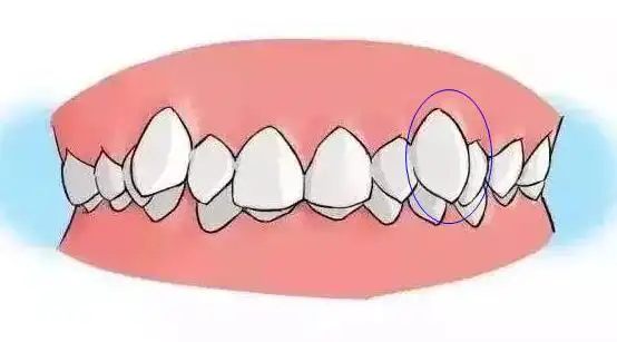 尖牙和虎牙是不是一样的,有没有什么区别