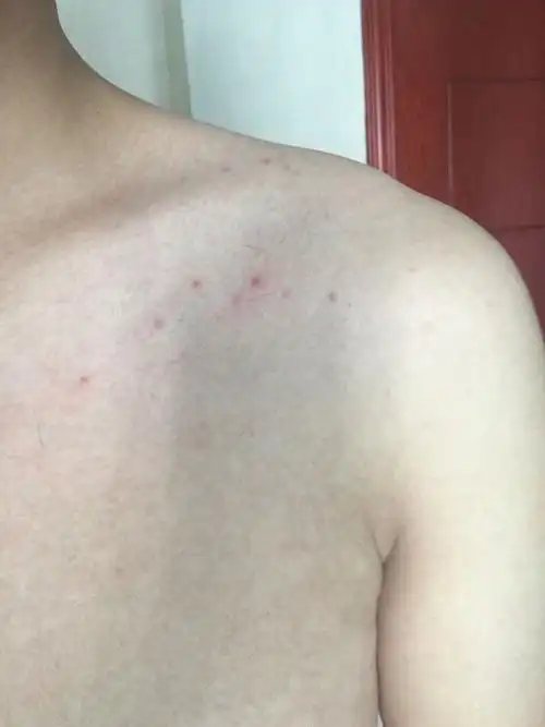 我胸前起的小红点是浅淋巴结肿大吗,还是其他?