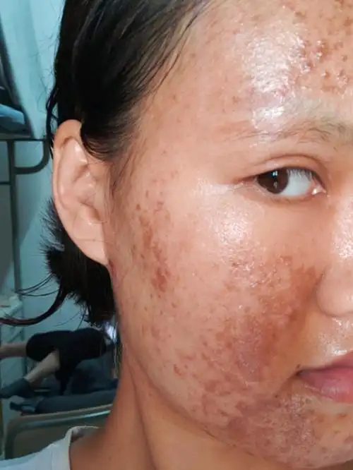 果酸焕肤第二天比昨天的结痂部位更暗沉了