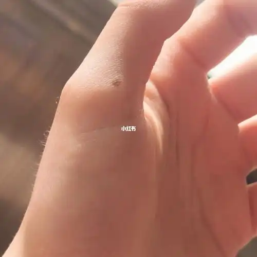 左手大拇指长痣小时候长的越长越大颜色越浅痣