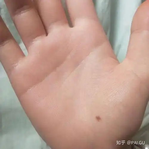 我的左手掌心有颗痣,突然很想找到右手掌心相同位置也有痣的人?
