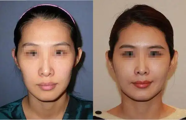 自体脂肪填充面部前后对比图.