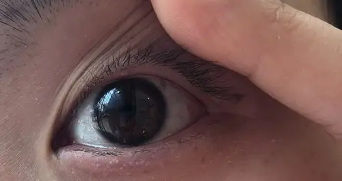 滴眼药水可以好吗?今天眼睑突然长了个透明的小泡,另一只眼睛眨的时候