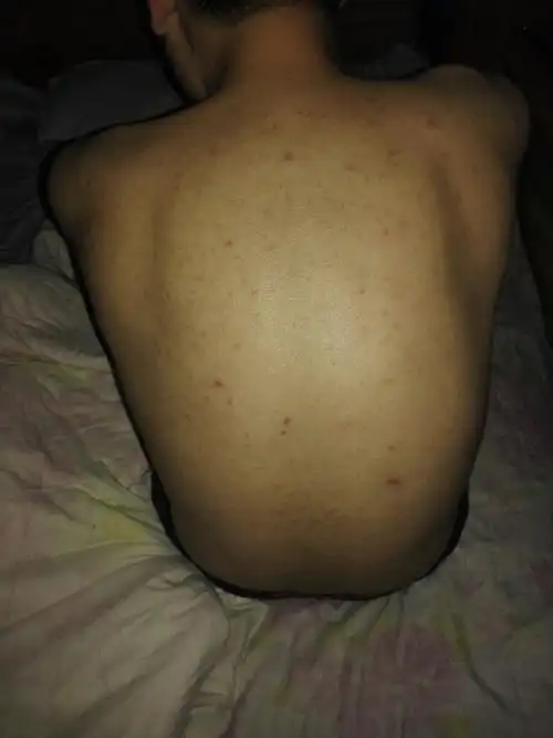 我后背毛孔粗大,出油,有黑头,现在又严重了,怎么办?