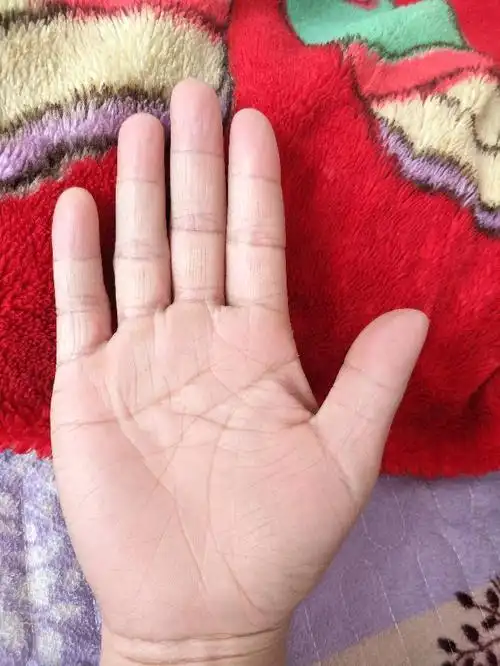 我的生命线尾端有个岛纹,代表什么疾病?