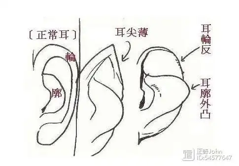 耳骨外翻面相耳骨外翻在相学称为轮飞廓反反骨耳性格比较反叛