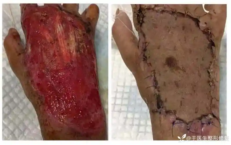 自制双层人工真皮修复热压伤后肌腱外露创面