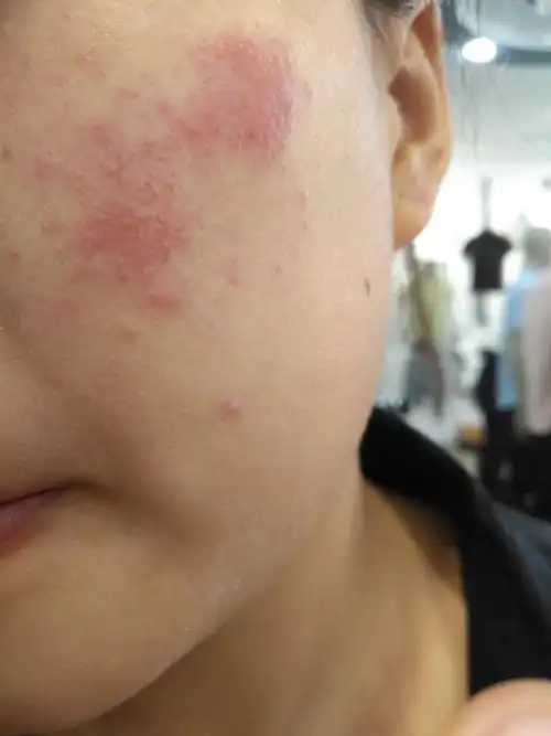 过敏性湿疹怎么治疗很痒 求帮忙