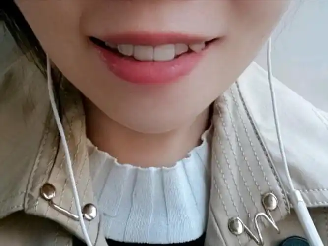 对自己的虎牙一直不是很满意,而且有点牙齿不齐,就到_圈子-新氧美容