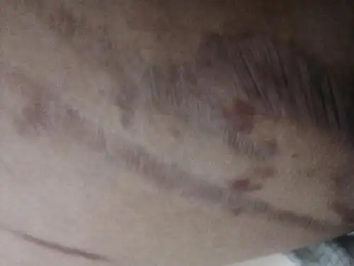 大腿内侧怎么了?黑色一条条