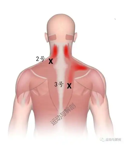 如何松解斜方肌触发点解决上背部头颈部疼痛问题