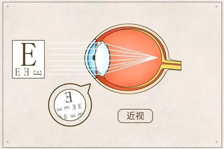 眼科梁秀栋:近视长期戴眼镜,眼睛变凸了怎么办?_眼球_角膜_手术