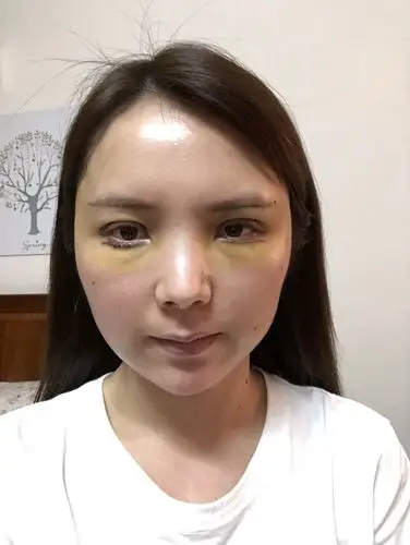 眼部多项加脂肪填充术后第五天,我本身底_新氧-专业医美服务平台