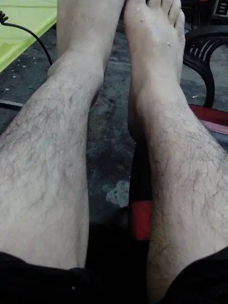 我才18岁身上好多毛啊 遗传的 问问有办法吗