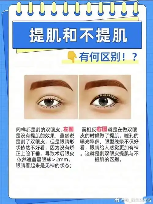 眼整形##无锡胡国强医生##提肌##上睑提肌无力##双眼皮##医疗科普