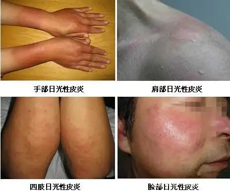 日光性皮炎的临床症状请自我对照