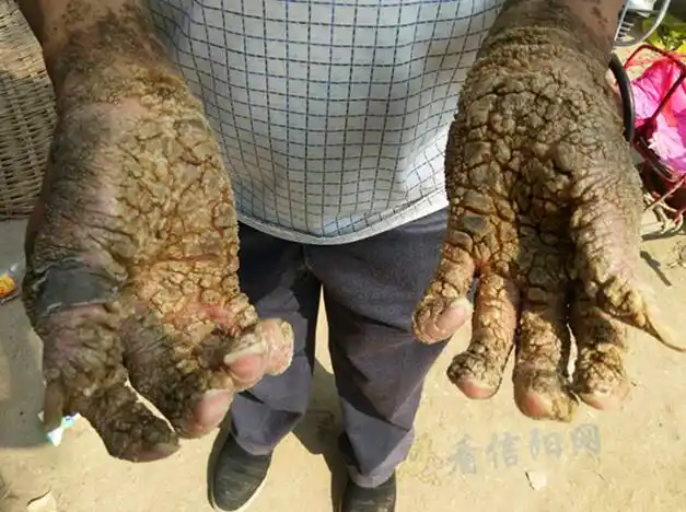 信阳一农民身患怪病,双手长满鳞片