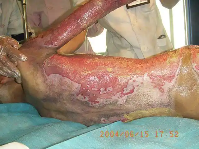 四川什邡川磷烧烫伤专科医院救治的一例特大面积烧伤患者